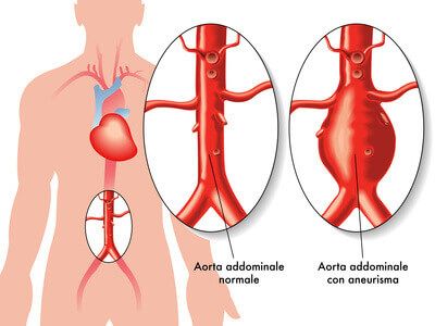 Riesgo de isquemia colónica luego de la reparación de aneurisma de aorta abdominal