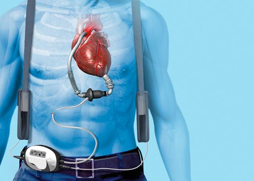 Asistencia ventricular en anatomías complejas y deterioro severo de la función ventricular izquierda