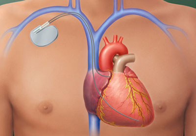 Evaluación Hemodinámica de la Insuficiencia Aórtica post TAVR