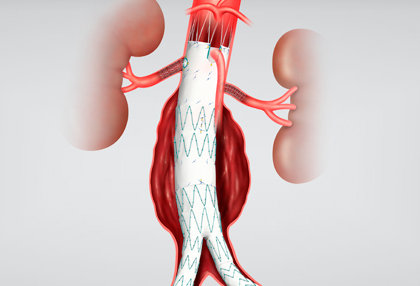 endoprotesis fenestradas aneurismas toracoabdominales