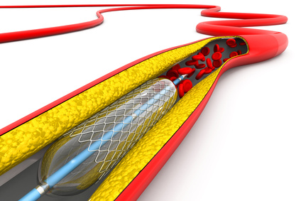 Stents en placas lipídicas vs fibrocálcicas ¿Diferente pronóstico? 