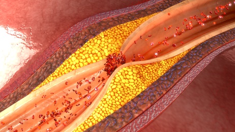 colesterol ldl placas coronarias