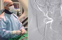 angioplastia carotidea video