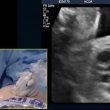 valvuloplastia aórtica fetal