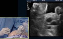 valvuloplastia aórtica fetal