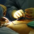 cirugia de revascularizacion miocardica