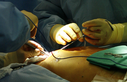 cirugia de revascularizacion miocardica