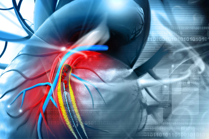 Técnica Doble Crush Doble Kissing vs. stent provisional