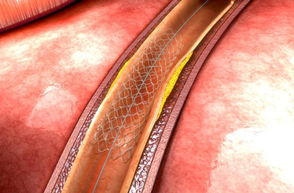 Zotarolimus con polímero permanente vs. biolimus con polímero degradable