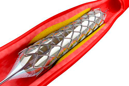 PRISON IV: DES with resorbable polymer vs. DES with permanent polymer in total occlusions