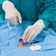 ¿Endarterectomía o angioplastia carotídea? la pregunta sigue motivando más estudios