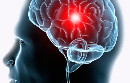 Estudio OBSERVANT II: Predictores de accidente cerebrovascular a 30 días y a 6 meses después del TAVI