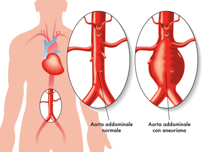 Modelo anatômico de aneurisma da aorta abdominal - 021 series