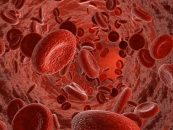 La anticoagulación jugando un papel controvertido en el TAVI