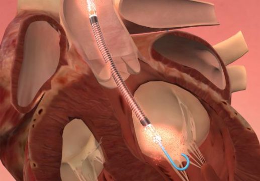 ¿Hay diferencias entre ambos sexos en ATC de alto riesgo asistidas por soporte circulatorio mecánico?