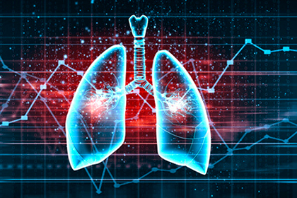 ¿Han cambiado las complicaciones relacionadas a la angioplastia pulmonar con balón desde sus inicios? 
