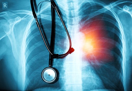 denervación pulmonar