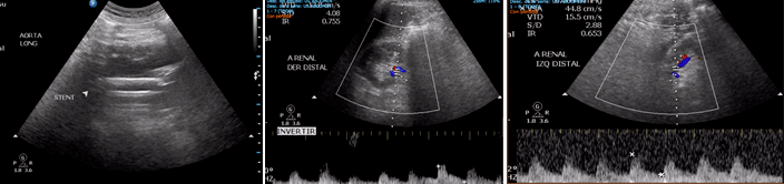 2° Caso SOLACI Peripheral Aneurisma de aorta abdominal yuxtarrenal