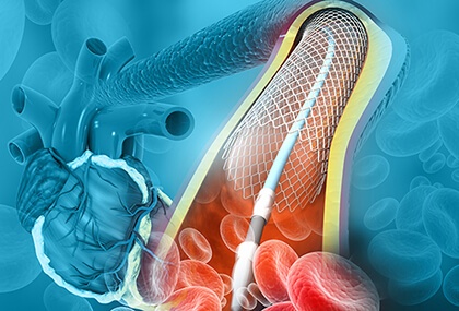 Stents liberadores de droga: ¿es importante el tamaño de los struts?