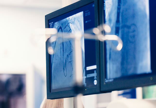 IVUS vs OCT para guiar la angioplastia ¿Cuál elegir?