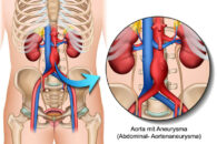 Manejo de los aneurismas de aorta abdominal en 2021