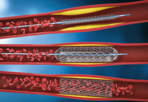 Resultado a 3 años luego de ATC con técnica de 2- stents vs Provisional stent por bifurcaciones complejas