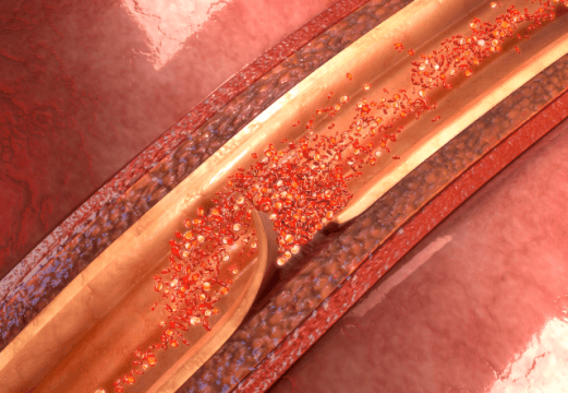 Disecciones coronarias y shock cardiogénico: ¿Cuál es su evolución?
