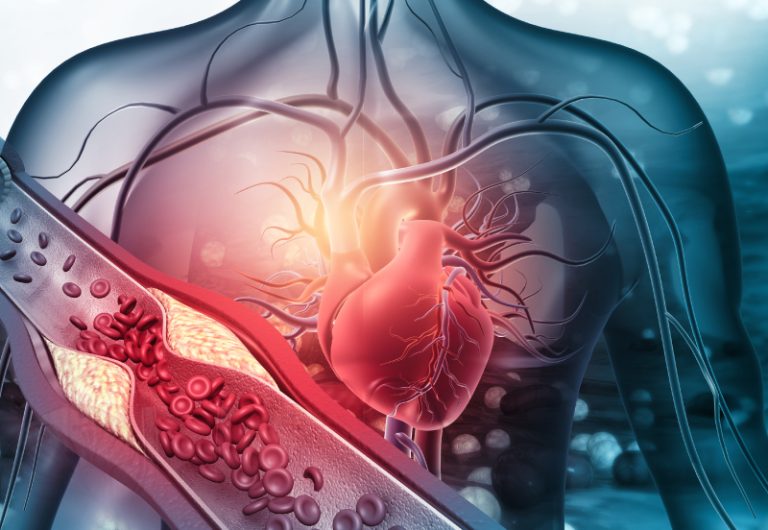 Correlación invasiva (CFR e IMR) con el slow flow coronario