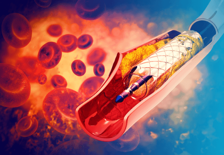 LIFE-BTK | Critical Limb Ischemia: Use of Bioresorbable Scaffold in Infrapatellar Lesions (LIFE-BTK)