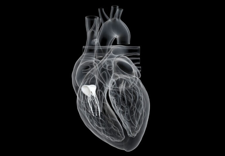 Cardioband na insuficiência da valva tricúspide