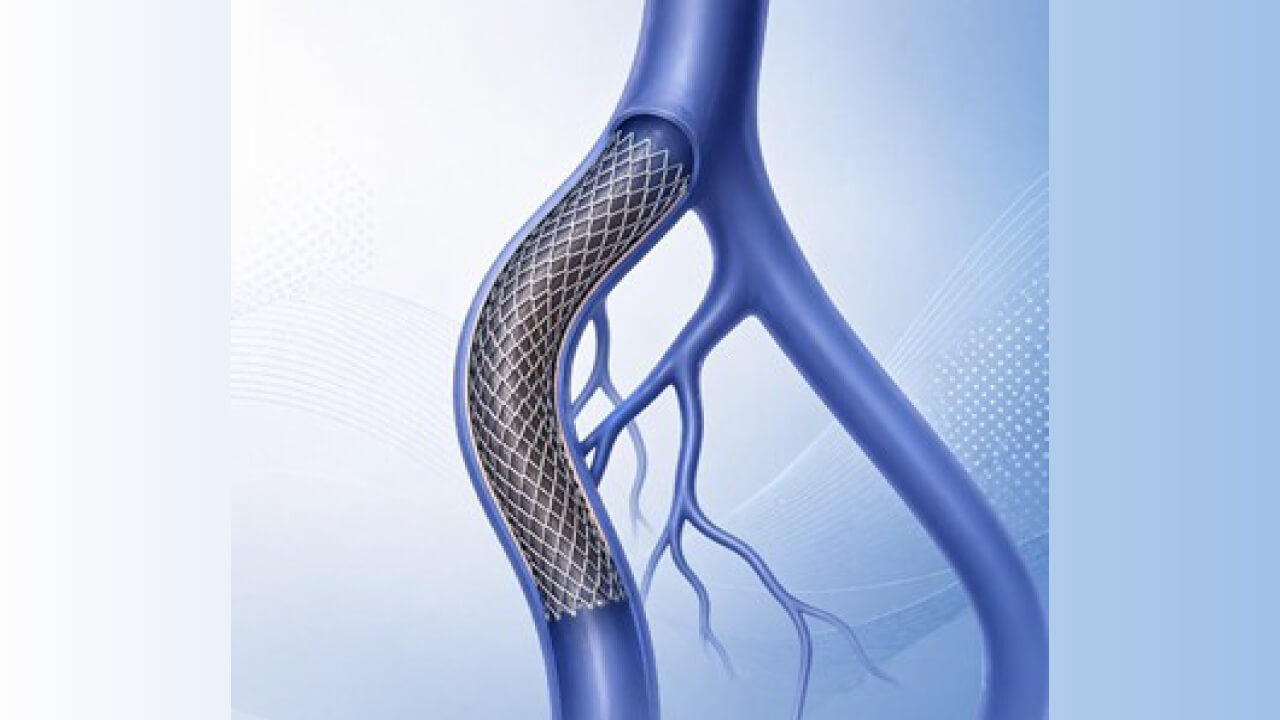 C-TRACT: terapia endovascular en el síndrome postrombótico por obstrucción ilíaca
